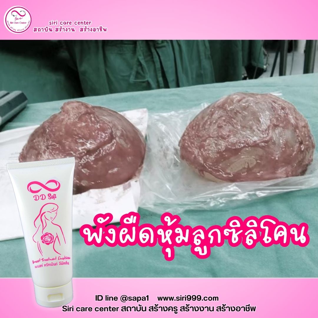 อิมัลชั่นสลายพังผืดทรวงอกซิลิโคน