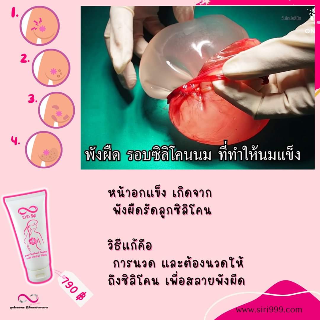 อิมัลชั่นสลายพังผืดทรวงอกซิลิโคน