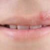 #เริม (Herpes simplex virus)
