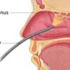 #เสมหะในลำคอมากเกินไป (excess mucus)
