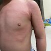 #ส่าไข้หรือไข้ผื่นกุหลาบ (roseola infantum)