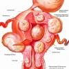 อาหารช่วยลดขนาดเนื้องอกมดลูก
