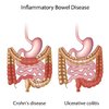 ลำไส้อักเสบ Inflammatory bowel disease (IBD)