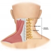 กระดูกสันหลังส่วนคอเสื่อม (Cervical spondylosis)