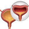 กระเพาะปัสสาวะที่ไวไป OAB (Overactive bladder)