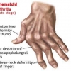 โรคข้ออักเสบรูมาตอยด์ (rheumatoid arthritis)