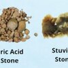 #นิ่วในไต(Kidney stones, renal calculi)