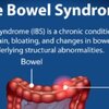 ลำไส้แปรปรวน Irritable Bowel Syndrome