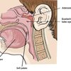 ต่อมอะดีนอยด์โต Enlarged Adenoid