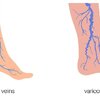 #เส้นเลือดขอด(Varicose Veins)