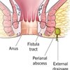 ฝีคัณฑสูตร (Anal Fistula หรือ Fistula – in – ano) หรือฝีเรื้อรังที่ก้น