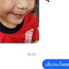กลากน้ำนม (Pityriasis Alba)