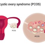 #PCOS-2