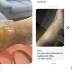 ตุ่มน้ำพอง(Bullous Pemphigoid)