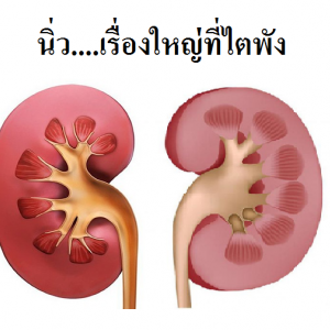 นิ่ว....เรื่องใหญ่ที่ไตพัง