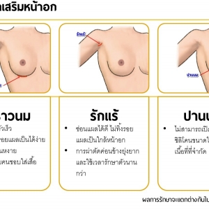 ก่อนจะผ่าตัดทำนม