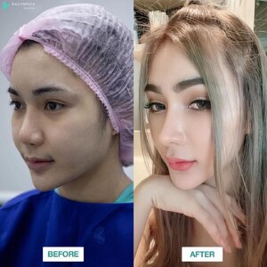 ปลูกผม โทร 095-5266242 เสริมหน้าอก เสริมจมูก ทำตา2ชั้น สำหรับผู้หญิงเรา ต้องสวย เพราะความสวยจะเปลี่ยนชีวิต