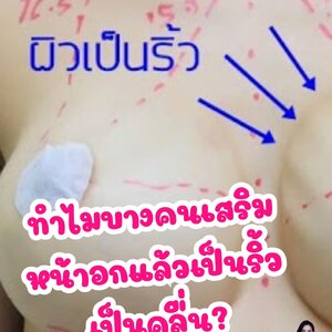 ทำไมบางคนเสริมหน้าอกแล้วเป็นริ้ว เป็นคลื่น?